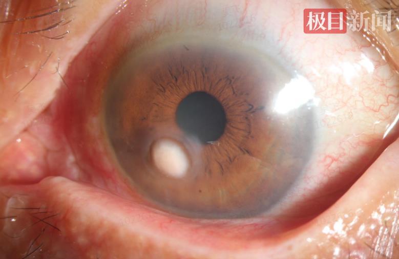 木柴弹伤左眼竟致角膜长出“蘑菇”！七旬农妇险失明