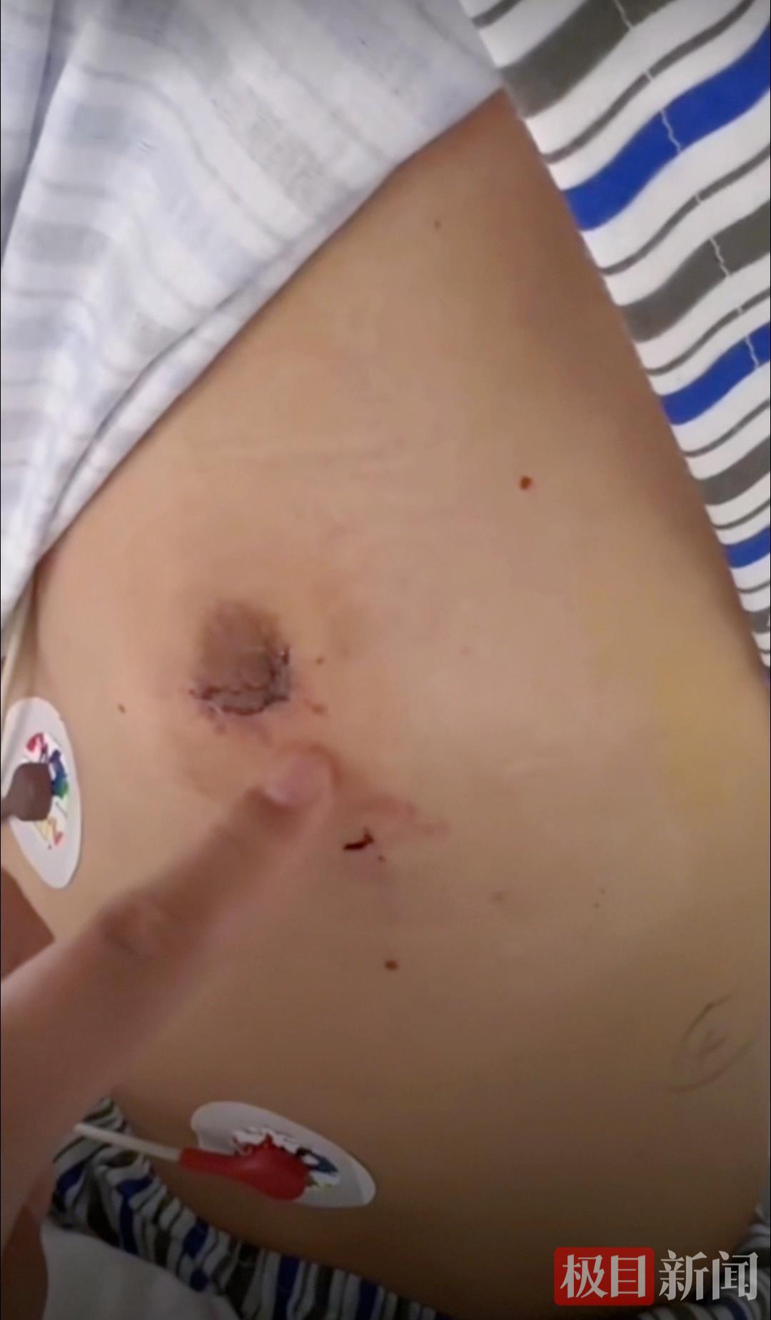 “三好男人”患肺腺癌，术后无痕！医生提醒：这类肺癌不吸烟也易得