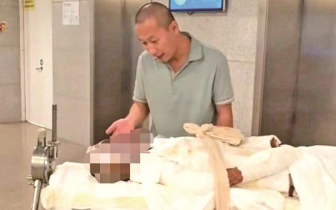 15岁女孩全身90%严重烧伤 打工父亲两次割皮救女