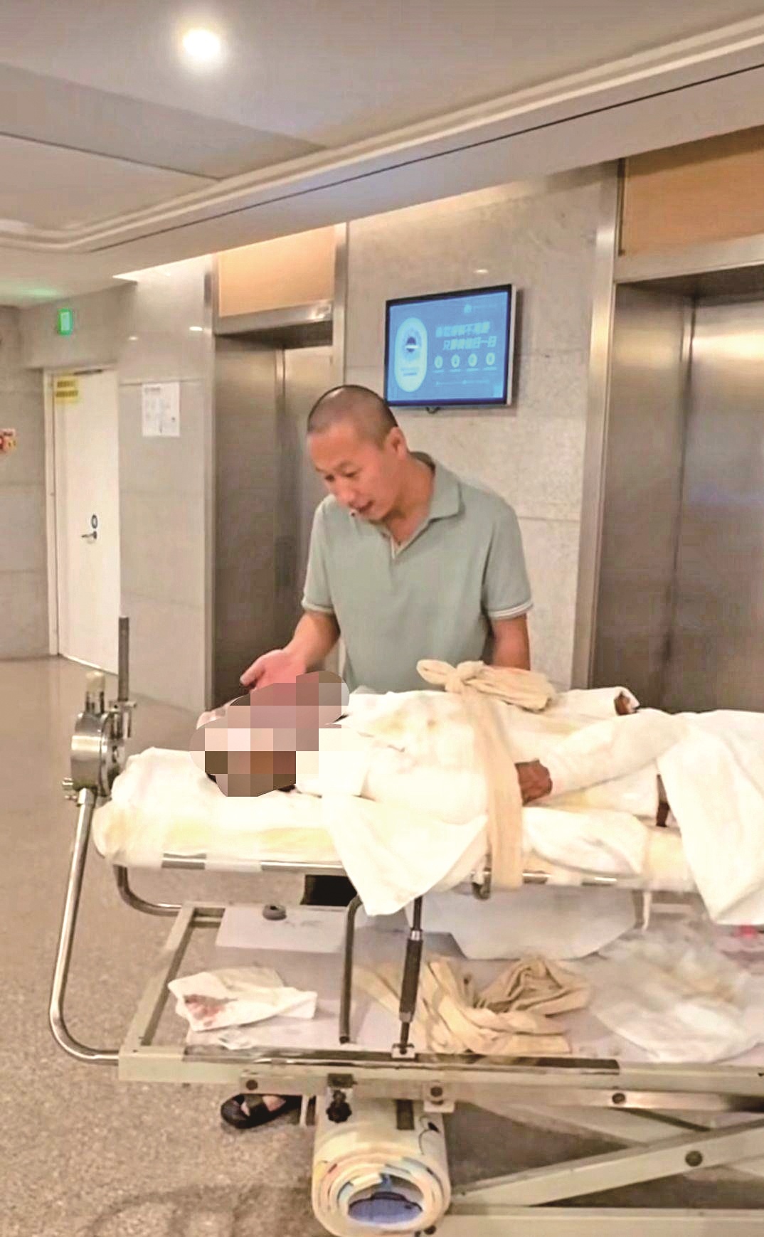 15岁女孩全身90%严重烧伤 打工父亲两次割皮救女