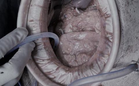 黄梅县二医院成功开展早期胃癌根治术