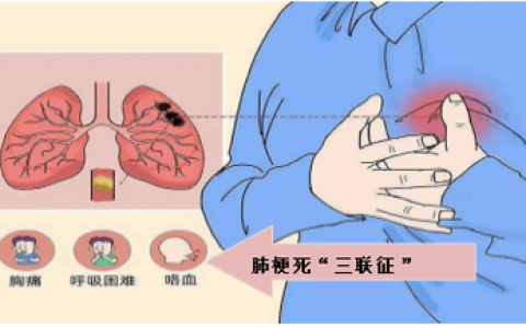 双肺被血栓“封喉”，生命悬于一线！多学科协作上演生死逆转