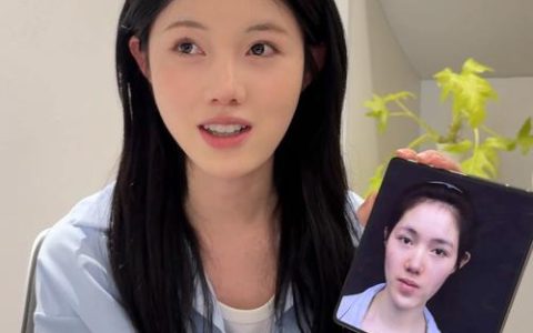 英山“田一针”让面瘫少女重拾灿烂笑容