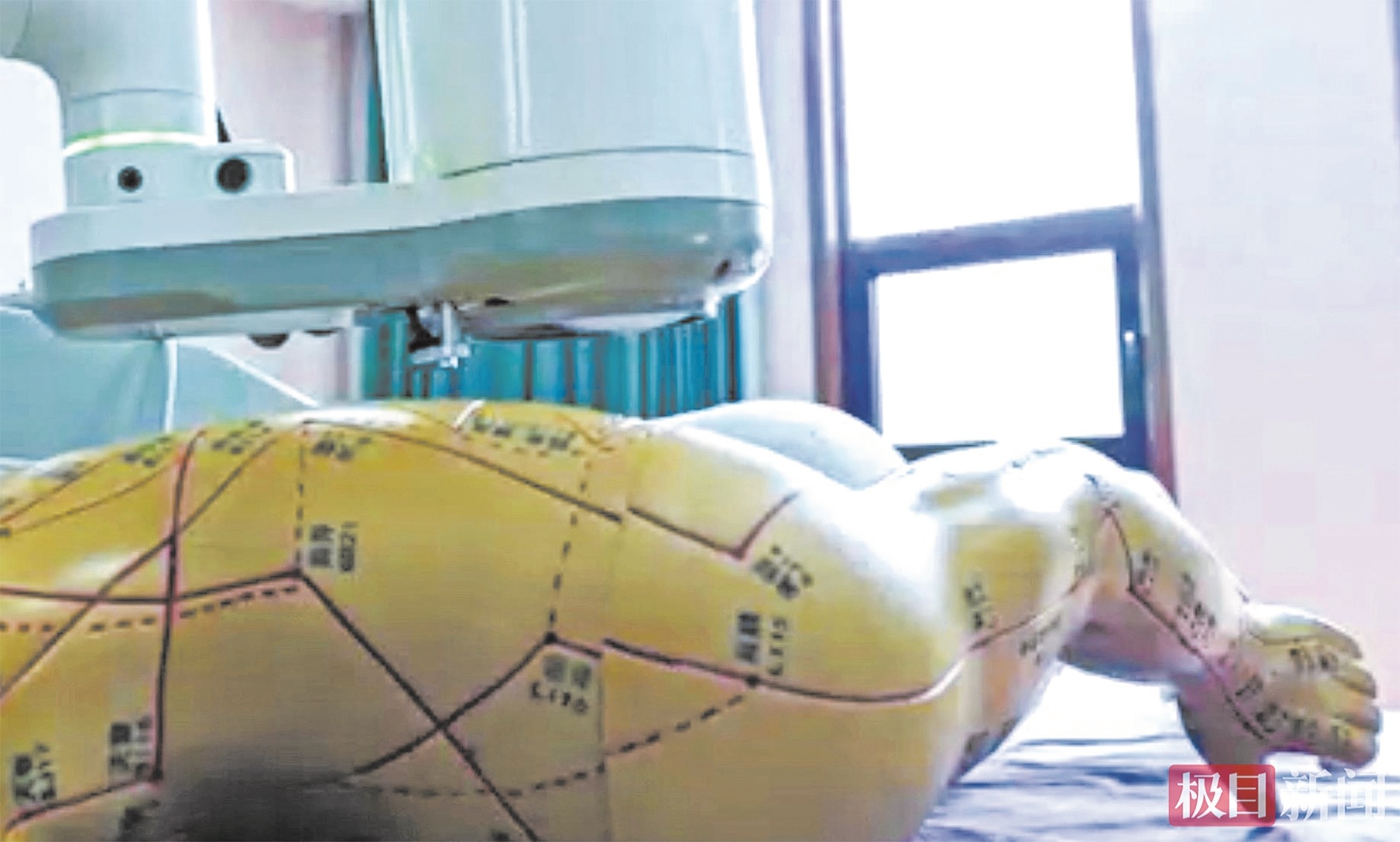 全球首台六轴智能艾灸机器人问世 穴位自动识别误差≤1.82mm