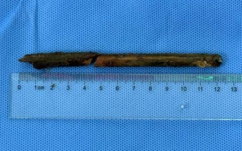 18年血透“生命线”告急 多学科联手“拆弹”攻坚