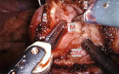 潜江市中心医院机器人辅助肾部分切除术造福患者