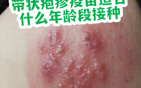 公卫学院冯硕团队国产新一代重组带状疱疹疫苗获新进展